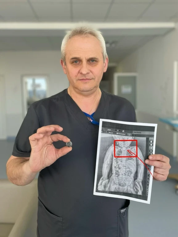Три місяці з літієвим живленням у стравоході: львівські хірурги врятували дворічну Софійку